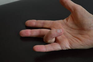 ayisha diaz - Trigger Finger - Susan Quin Physiotherapy