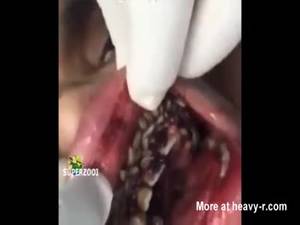 Mouth Insertion Porn - Maggot Mouth