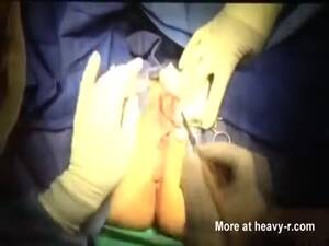 Circumcised - Female Circumcision, Labiaplasty