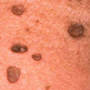 Baby Born With Warts On Anal Area - Purple and black skin tags may bleed as part of the healing process.