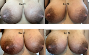 lactating breast when not pregnant - Mastitis, Engorgement, and Breast Complications (with Images)