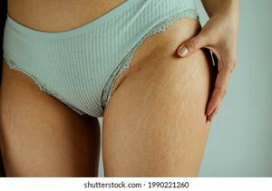 fat teen stretch marks - 800 Stretch Marks Man Images, Stock Photos, 3D objects, & Vectors |  Shutterstock