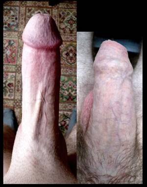 Circumcised - Before/after pic of my low and tight cut : r/circumcision