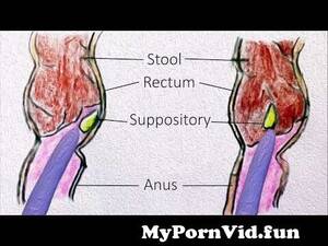 anal inflammation - Rectal Suppositories - How to use them? from 3g anal Watch Video -  MyPornVid.fun