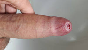 indian foreskin sex - Penis with tight foreskin