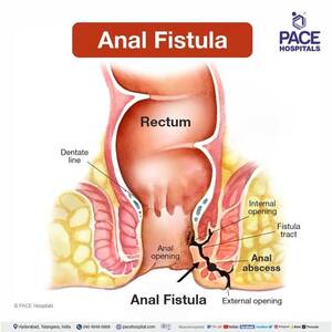 clips4sale anal - Anal fistula - Symptoms, Causes, Types, Complications, Prevention