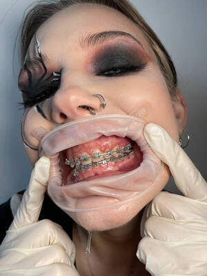 Braces Fetish Porn Tumblr - Braces Fetish Porn Tumblr | Sex Pictures Pass
