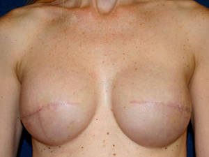 extra large saline breast implants - Silicone breast implants are safe, but don 't last very long, the FDA .