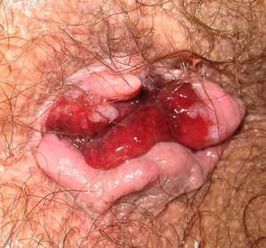 hemorrhoids from anal sex - Anal intercourse hemorrhoids