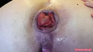 extreme anal rosebud - BBW extreme anal insertions with rosebud and cervix prolapse | xHamster