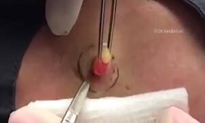fat bumps - Yellow fatty lump bursts out of a man's arm as a doctor cuts into it with a  scalpel | Daily Mail Online
