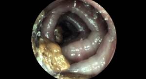 colon cam - My girl swallow the pill cam - video 5 colon - ThisVid.com em inglÃªs