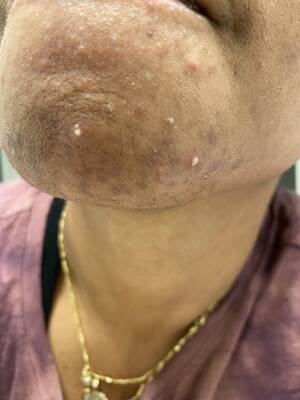 Acne Porn - PCOS + Nurse Mask Acne= Pimple Porn and Lady Beard : r/popping