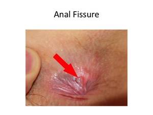 Anal Wart Cream - Anal fissure or piles