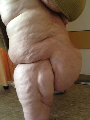 fat bumps - 