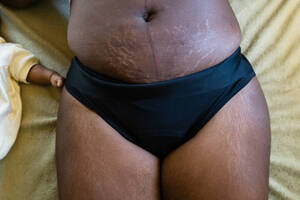 fat teen stretch marks - 350+ Black Woman Stretch Marks Stock Photos, Pictures & Royalty-Free Images  - iStock