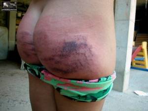 asian spanking bruised butts - spanking picture