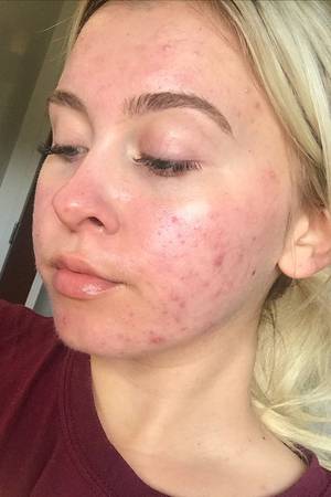 Nose Bump Porn - Instagram