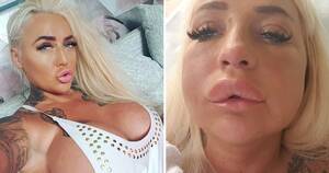 Botox Lips Porn - Porn star rushed to A&E after allergic reaction to lip job | Metro News