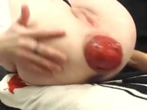 anal sex pump - Prolapsed Anus After Vacuum Pumping