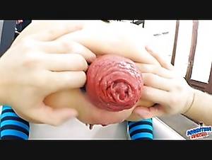 longest anal prolapse - 