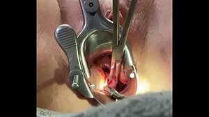 Cervix Dilation Porn - Holding cervix w tenaculum while 8mm dilator fucks uterus - XVIDEOS.COM