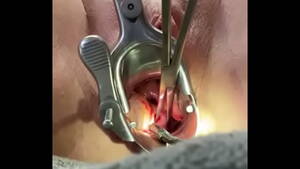 Cervix Dilation Porn - Holding cervix w tenaculum while 8mm dilator fucks uterus - XVIDEOS.COM