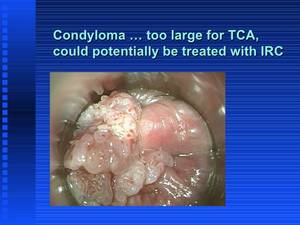 internal anal warts - Anal Warts. Briana Banks Gape