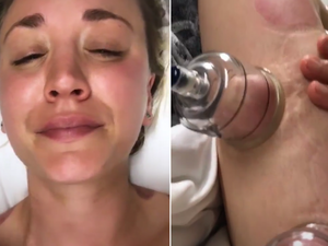 Kaley Cuoco Leaked Sex Tape - Kaley Cuoco Shares Painful Video of Cupping Therapy: Does It Work?