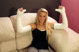 Arm Cast Fetish Porn - Double long arm cast DLAC Tumblr Porn