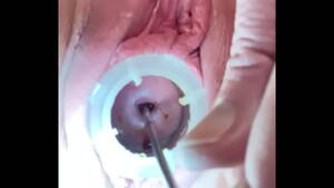 Cervix Dilation Porn - DilataciÃ³n profunda del orificio cervical con sonido doloroso - XVIDEOS.COM