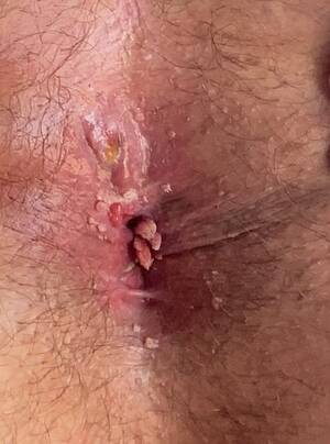 internal anal warts - Complications from Anal Warts Surgery? : r/askgaybros