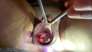 Cervix Dilation Porn - Painful cervix dilation using Tenaculum - XNXX.COM