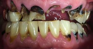 Cocaine Mouth - Meth Mouth: Meth abuse ruins your teeth and gums