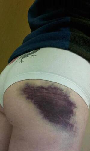 ass bruise - Now this is an ass bruise, good sir! : r/WTF
