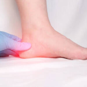 foot heel bruise - Bruised heel bone can be painful! Causes, Symptoms & Treatments