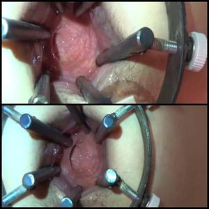 extreme anal stretching speculum - (07.04.2016) XXXL Anal Speculum Stretching â€“ Extreme JAV Porn