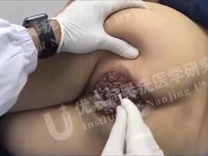 internal anal warts - ANAL WARTS? (NSFW)