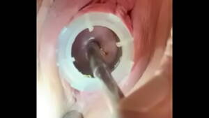 Cervix Dilation Porn - Watch 8mm electrosound puckering my cervix as I squeal from - XVIDEOS.COM