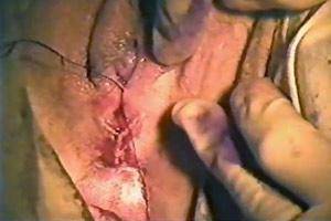 Circumcised Vagina Female Circumcision Porn - Femal Genital Mutilation