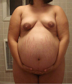 fat stretch marks - in Belly ...