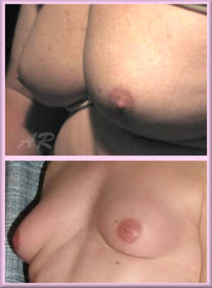 developing shemale tits - Breast Development in MTF Transsexuals | ReneeReyes.com