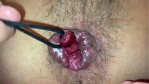 hemorrhoids from anal sex - Tie Up And Route The Internal Hemorrhoids - xxx Mobile Porno Videos &  Movies - iPornTV.Net