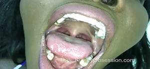 Mouth Fetish Porn - Mouth Fetish - Osa Lovely's Braces Mouth Tour