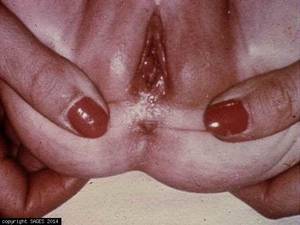 anal thrombosis - Surgery of the anus