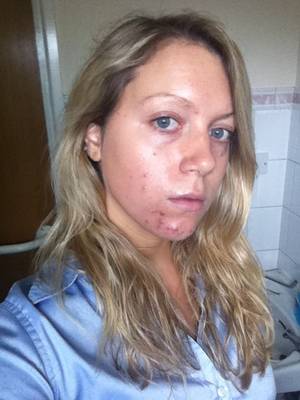 Acne Teen - My skin prior to Epiduo but during topical treatments