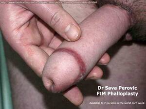 Ftm Penis Porn - FtM Penis Surgery