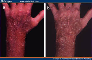 Anal Wart Cream - Usuario o direcciÃ³n de correo: ContraseÃ±a: Recuperar contraseÃ±a.