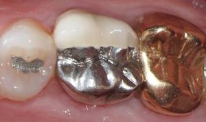Mouth Dental - Different metals in mouth cause dental galvanism.
