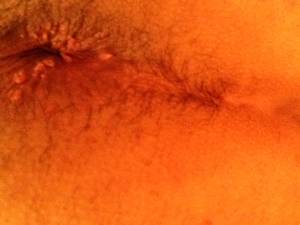 hard anal lump - Hard lump around anus Â· Asian recipes noodles chicken broth